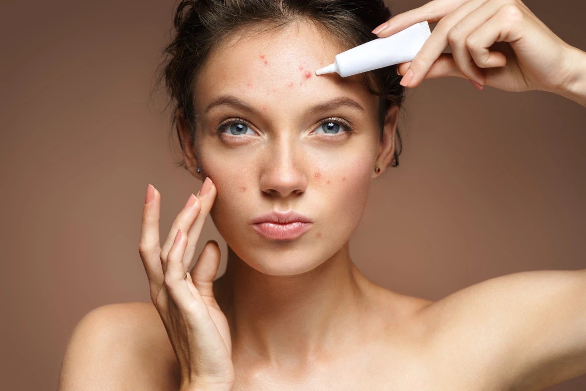 Acne negli adulti: cause, rimedi e consigli per una pelle sana