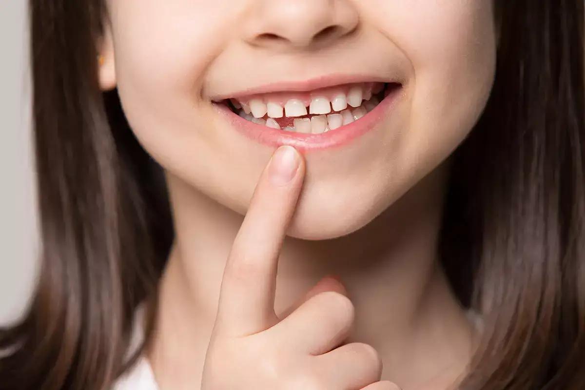 Denti storti nei bambini: come e quando intervenire?